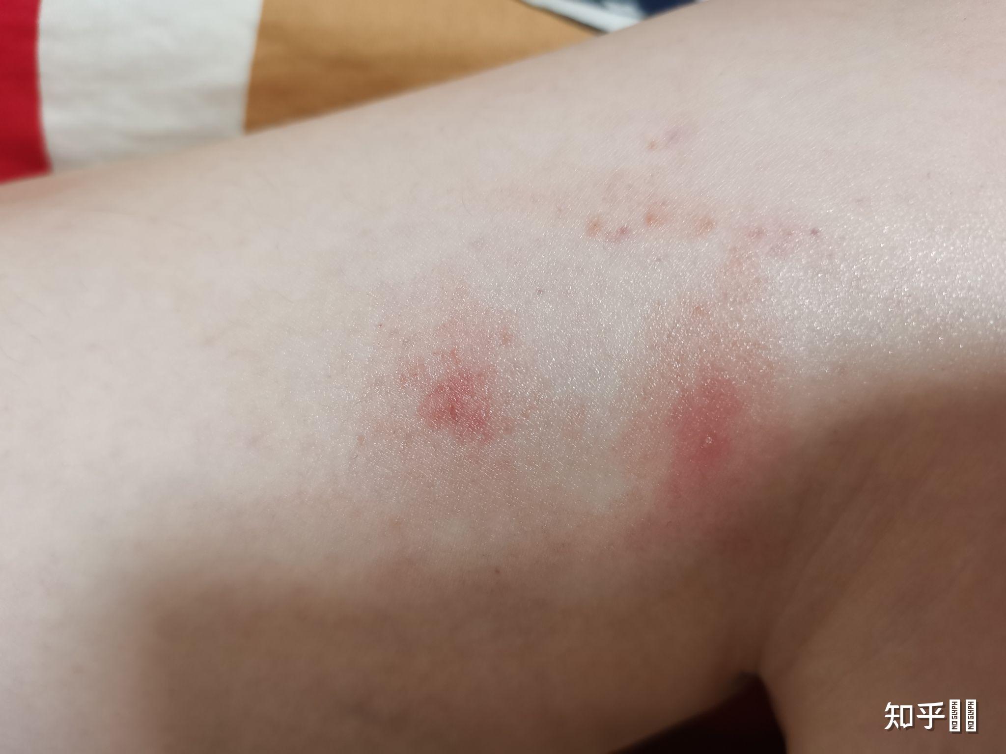 为什么被蚊子咬后肿包会变成一片出血点? - 知乎