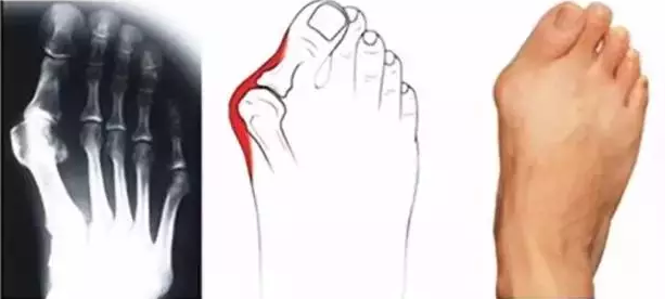 关于拇外翻，读懂这一篇就够了 - 知乎