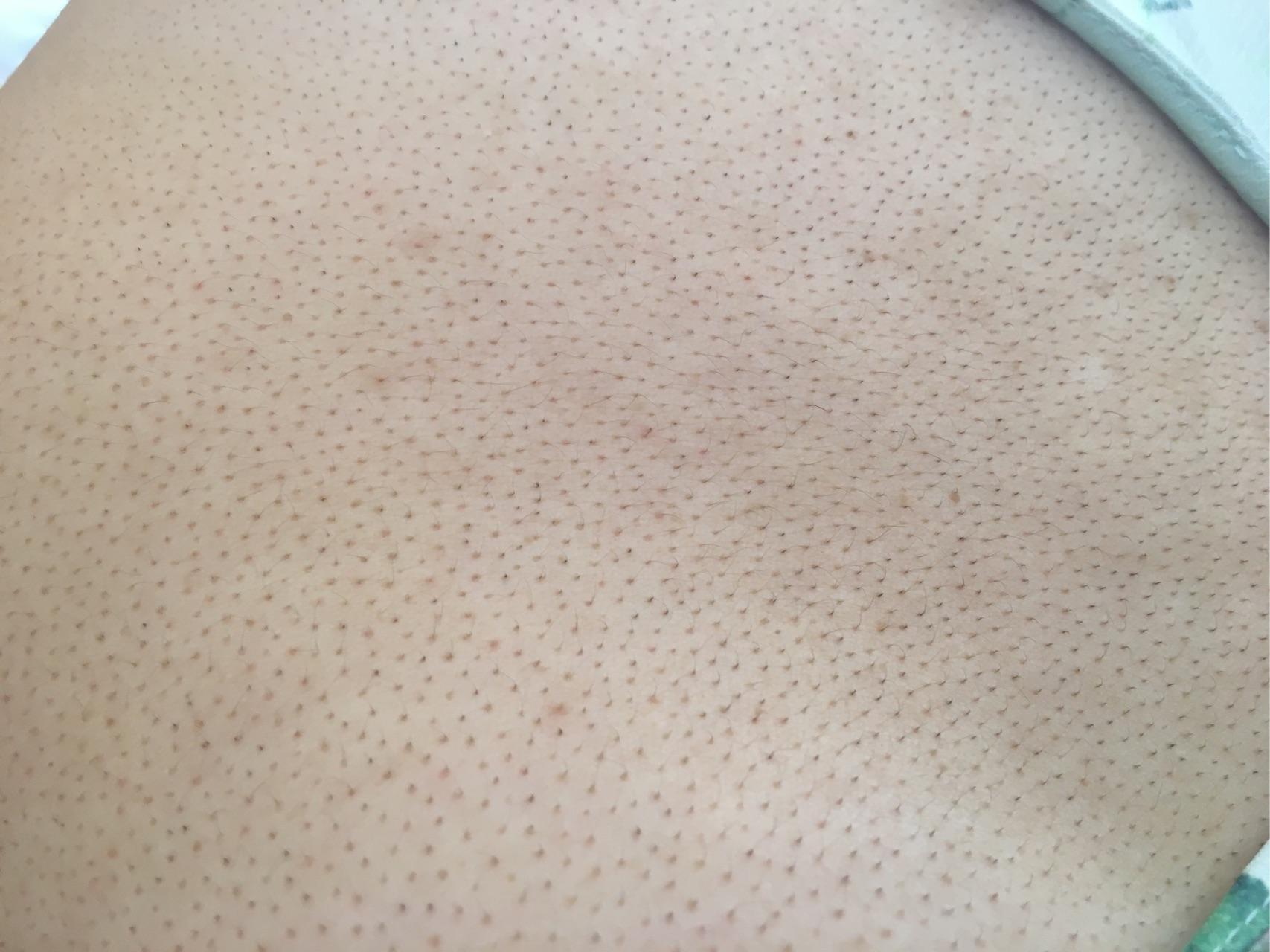 女生背上毛孔粗大怎么办