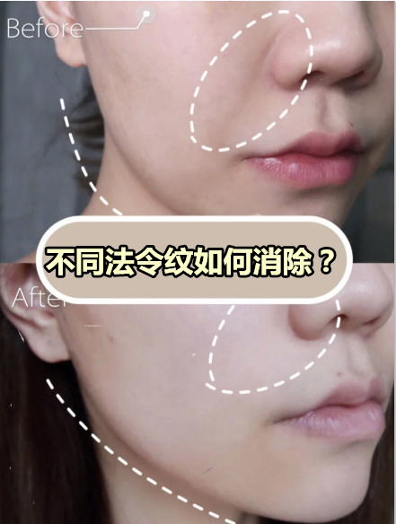 不同法令纹如何消除？ - 知乎