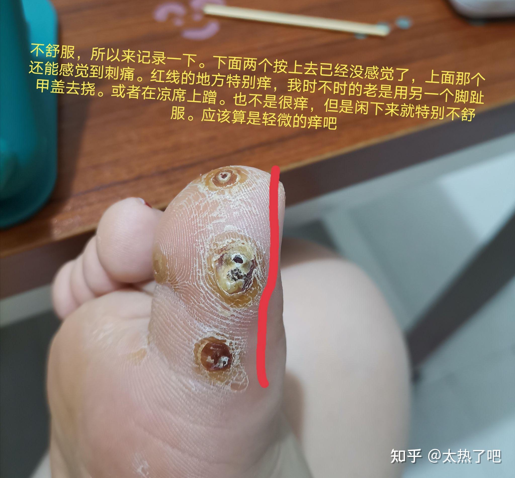 蹠疣和雞眼有什麼區別醫學上有沒有什麼治療蹠疣的好辦法