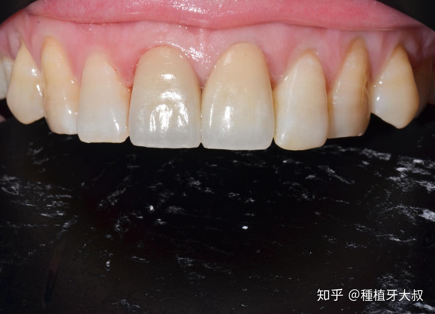 门牙牙缝大,那些做过牙冠和牙贴面的过来聊聊做后的感受呗? - 知乎
