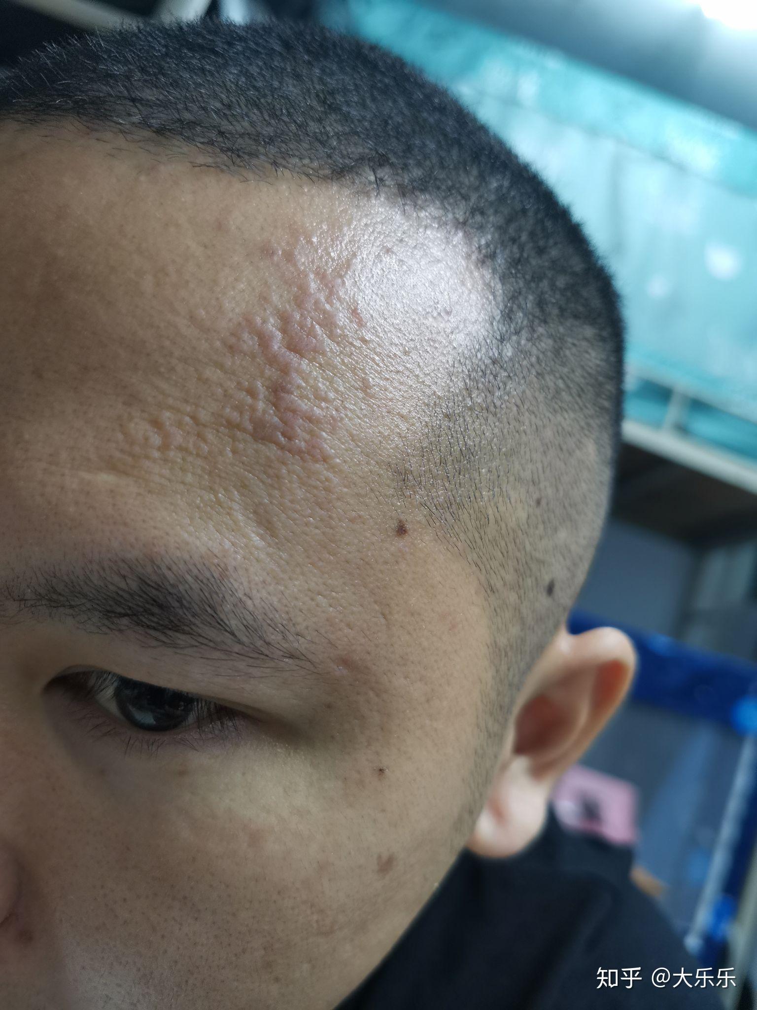 额头上这不会是扁平疣吧? - 知乎