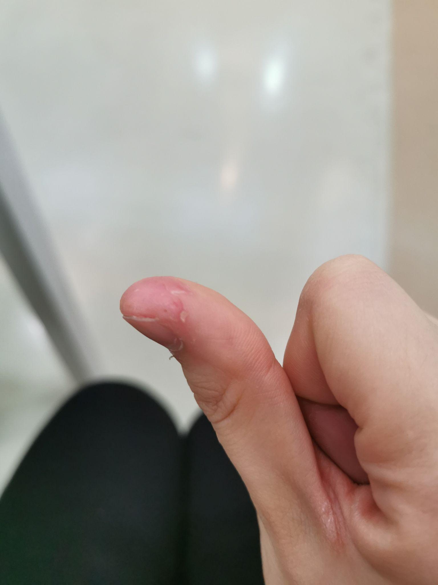 克制不住的抠手指头是心理问题吗?