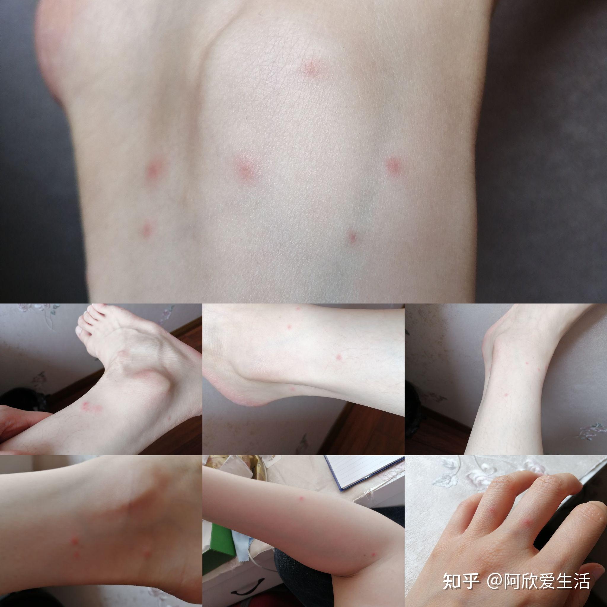 被毒蚊子咬后如何快速消肿止痒? - 知乎