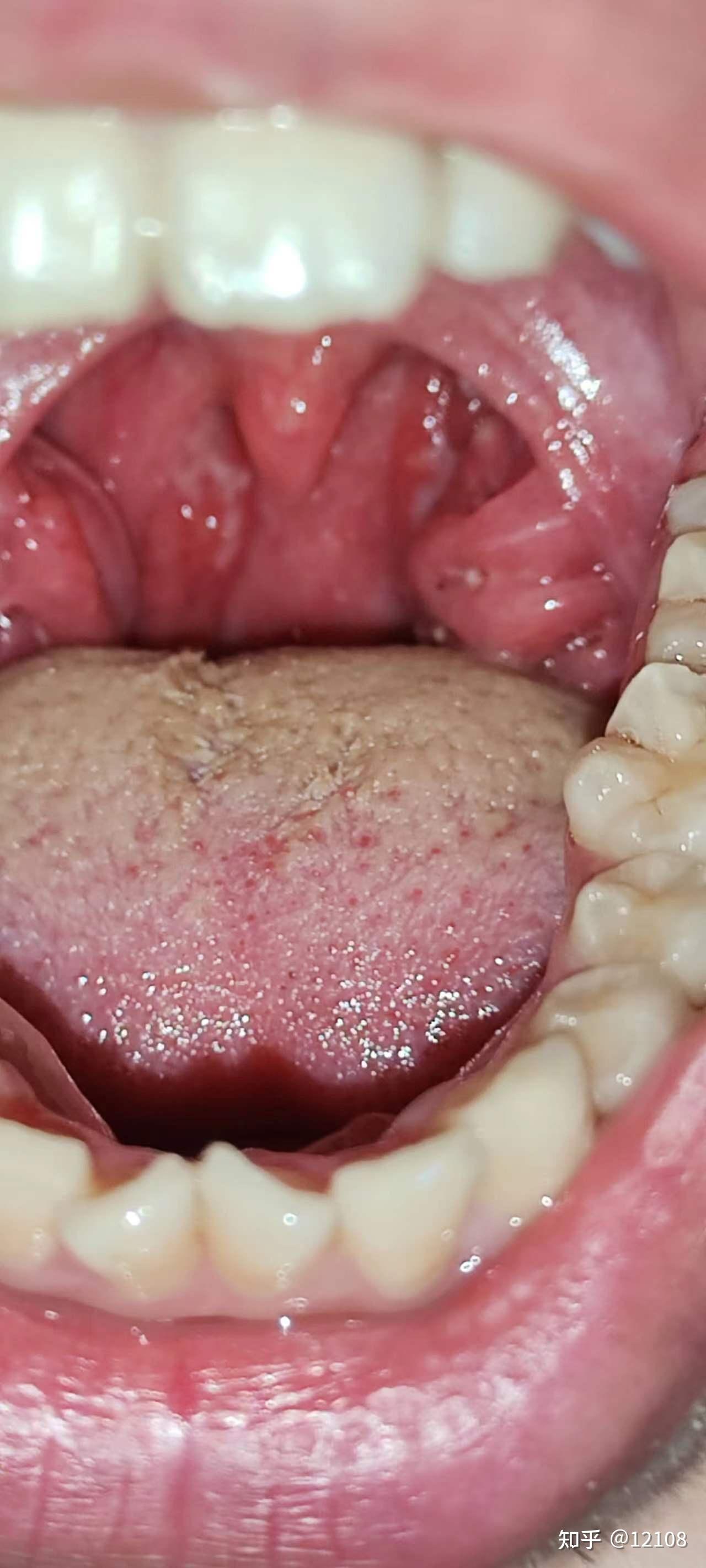 扁桃体发炎的症状有哪些?