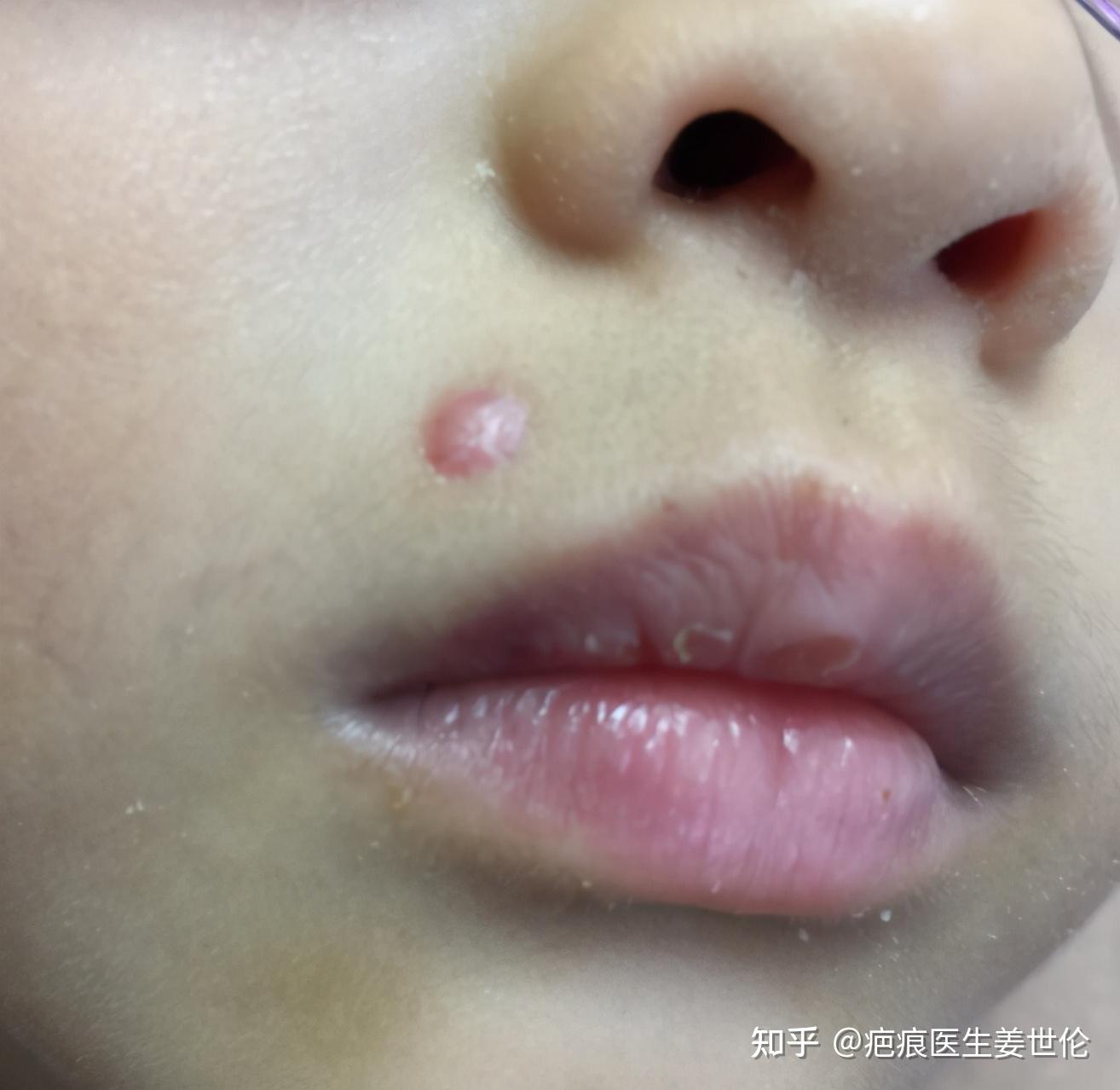 点痣后的疤痕增生如何修复? - 知乎