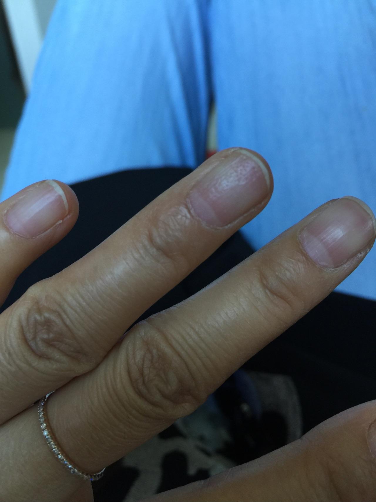 我的指甲上有很多小坑,好几年了,怎么回事? 