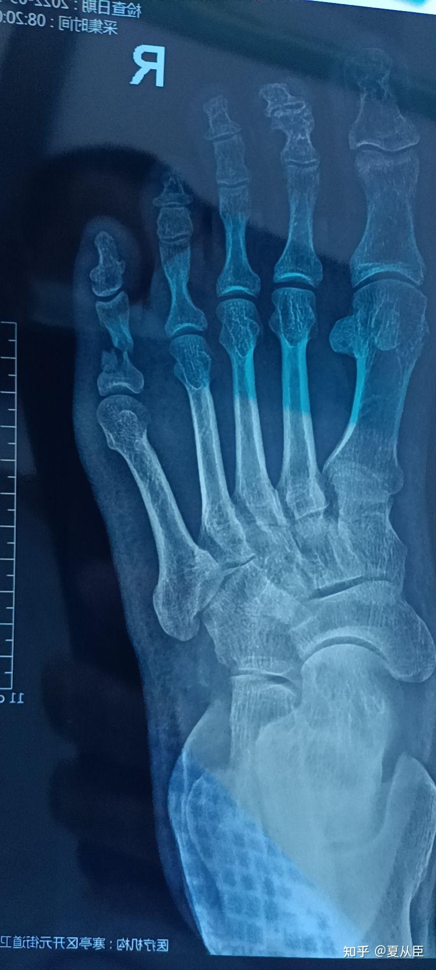 小脚趾头骨折二十多天还要不要打石膏? - 知乎