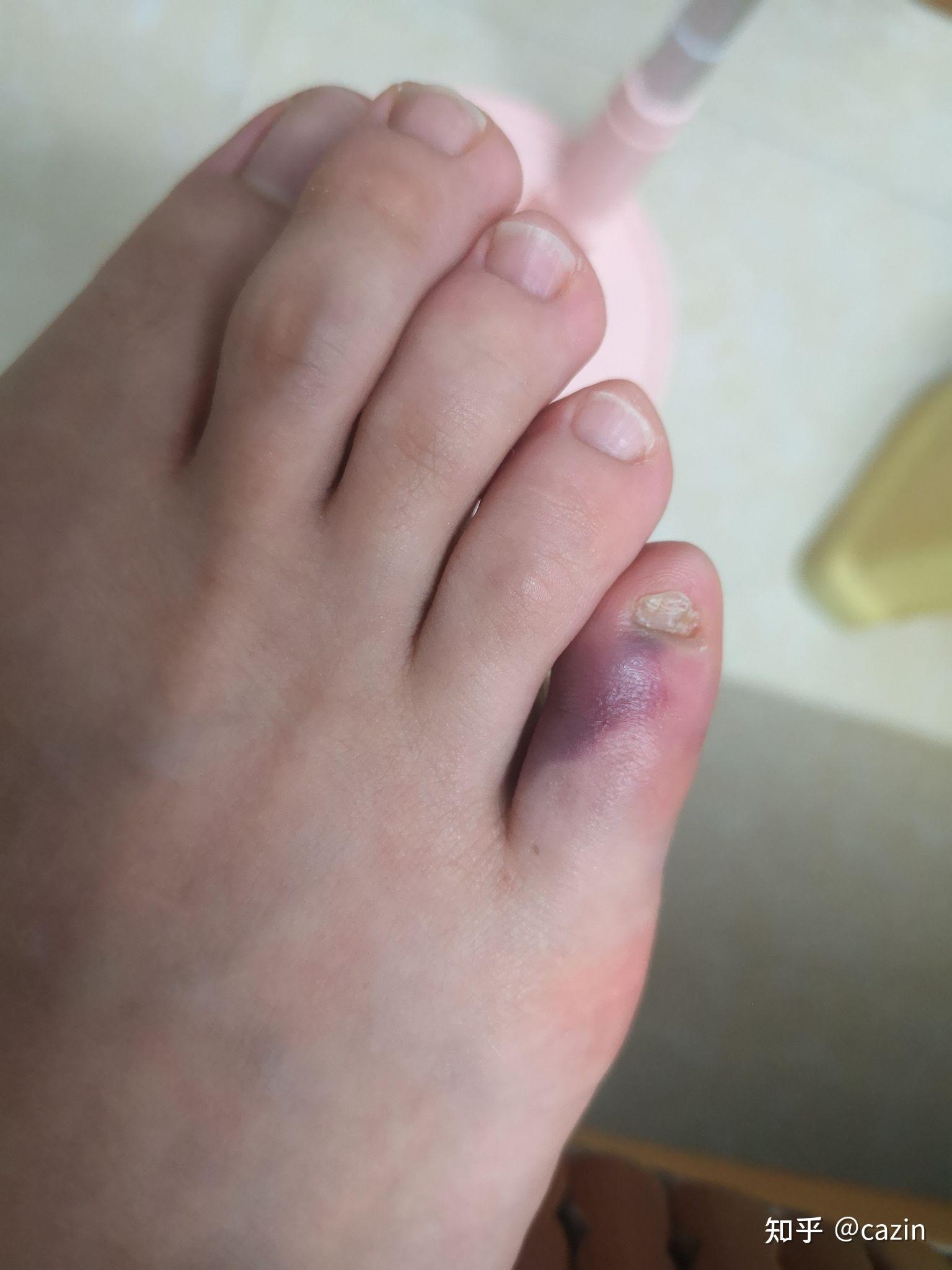 小脚趾撞到能疼叫不出声,有没有把小脚趾撞断过,是什么感觉? - 知乎