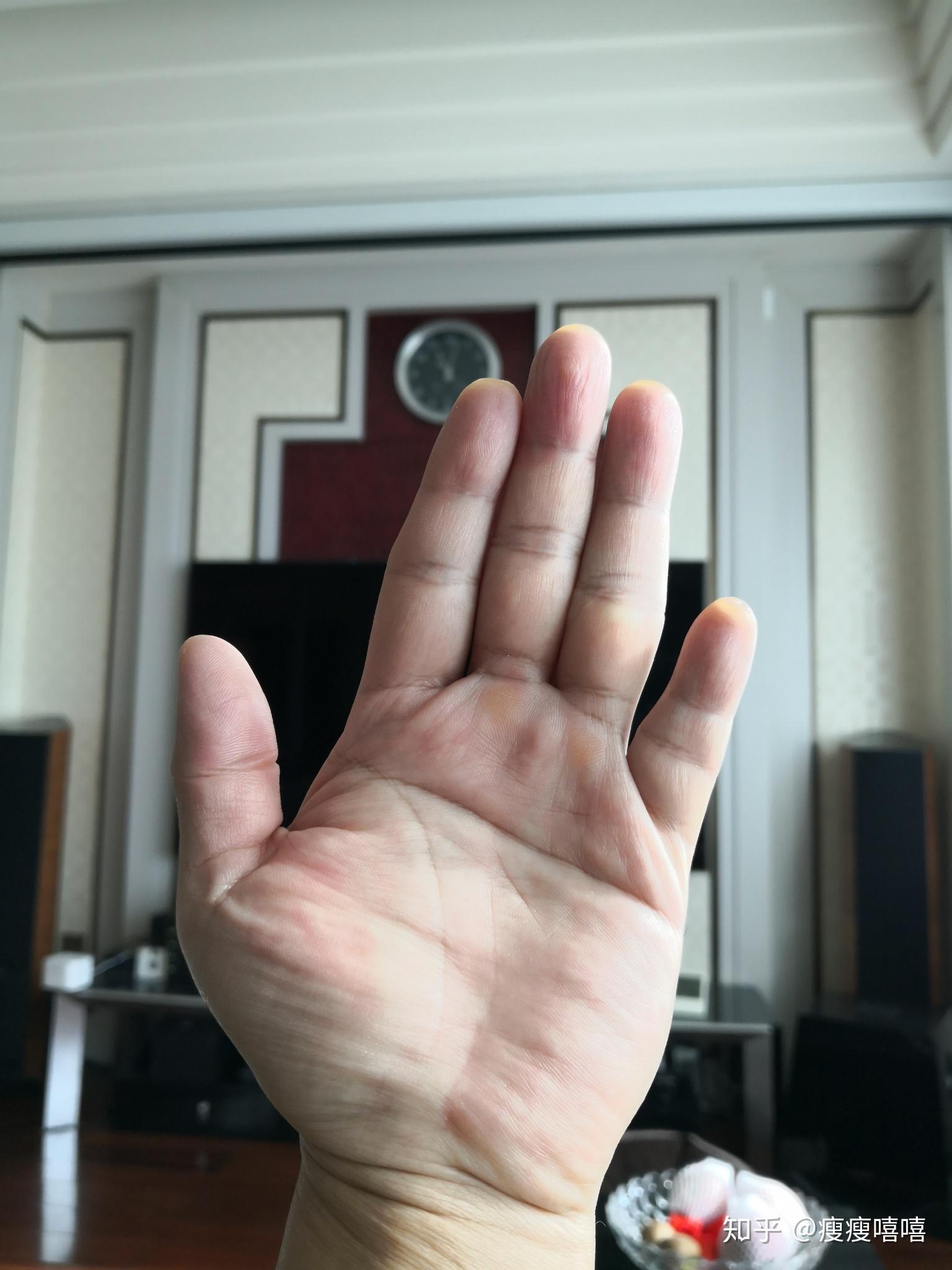 我的小拇指特别短特别奇怪究竟是为什么