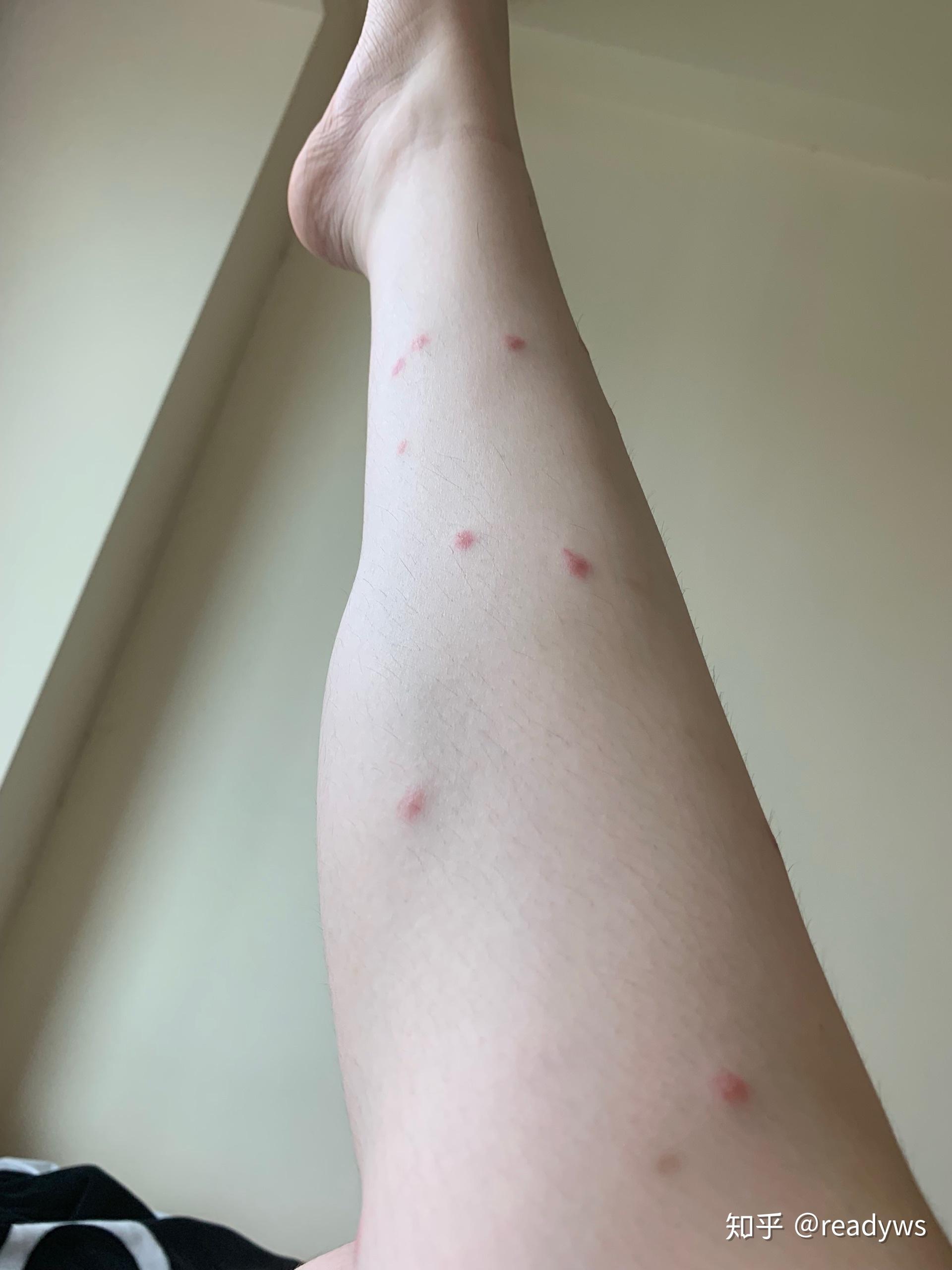 被跳蚤咬的全身都是包是什么样的感受