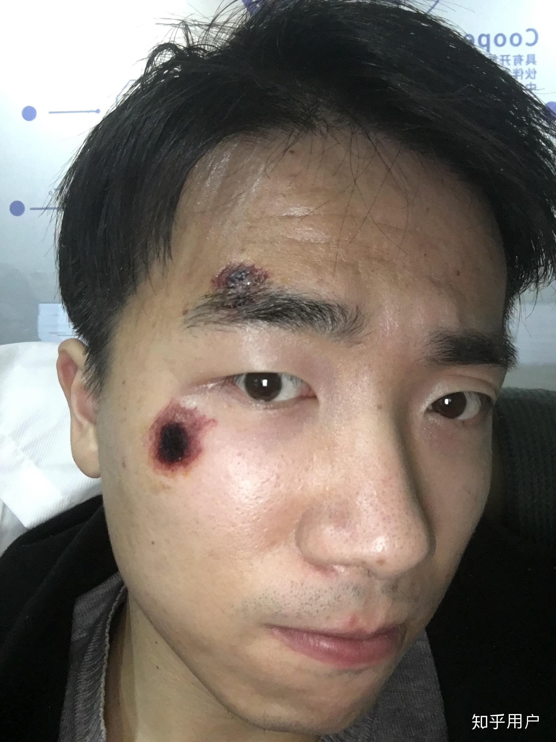 脸部擦伤如图请问如何恢复