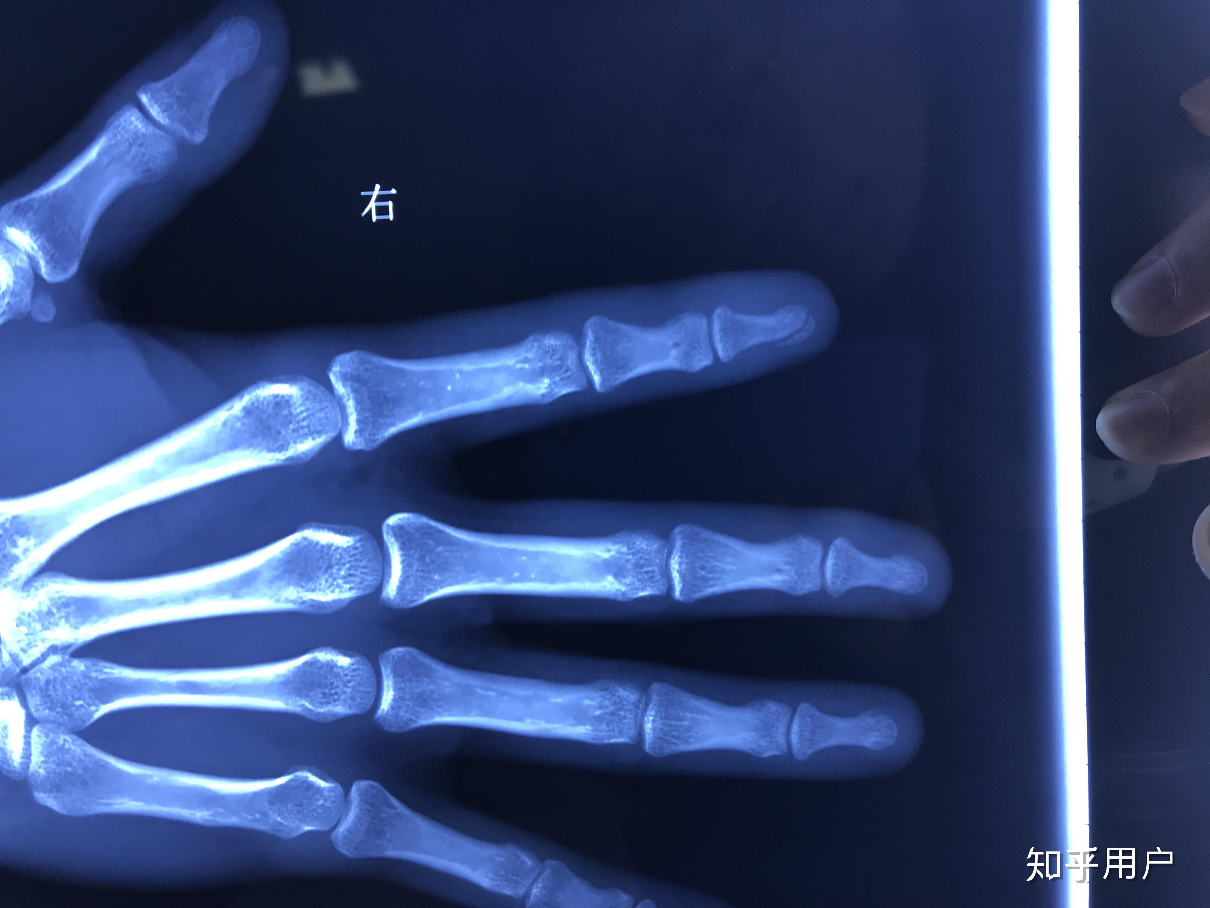 手指头骨折是种怎样的体验? - 知乎