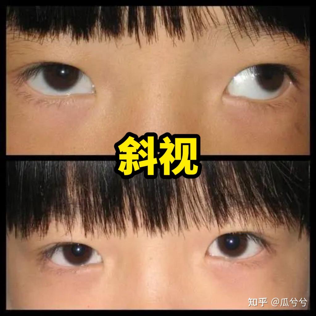 斜视会对眼睛造成什么危害?