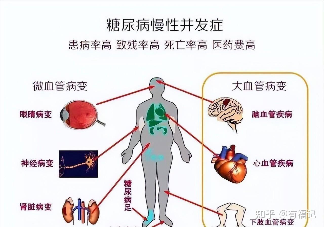 糖尿病有哪些并发症又该如何预防