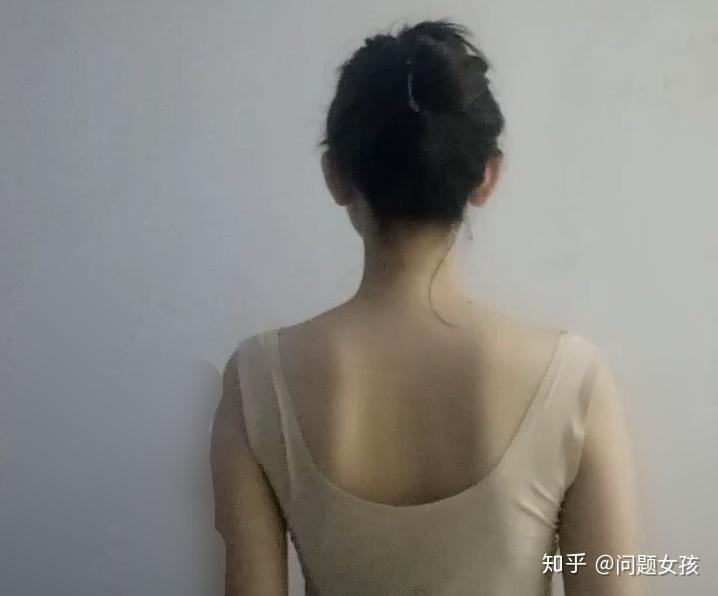 为什么有的人背部骨头突出? - 知乎