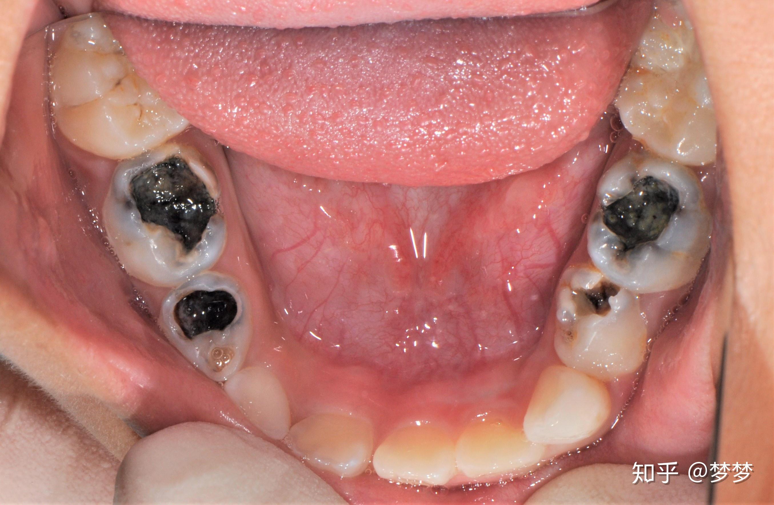 牙医碰见最烂的牙有多烂? - 知乎