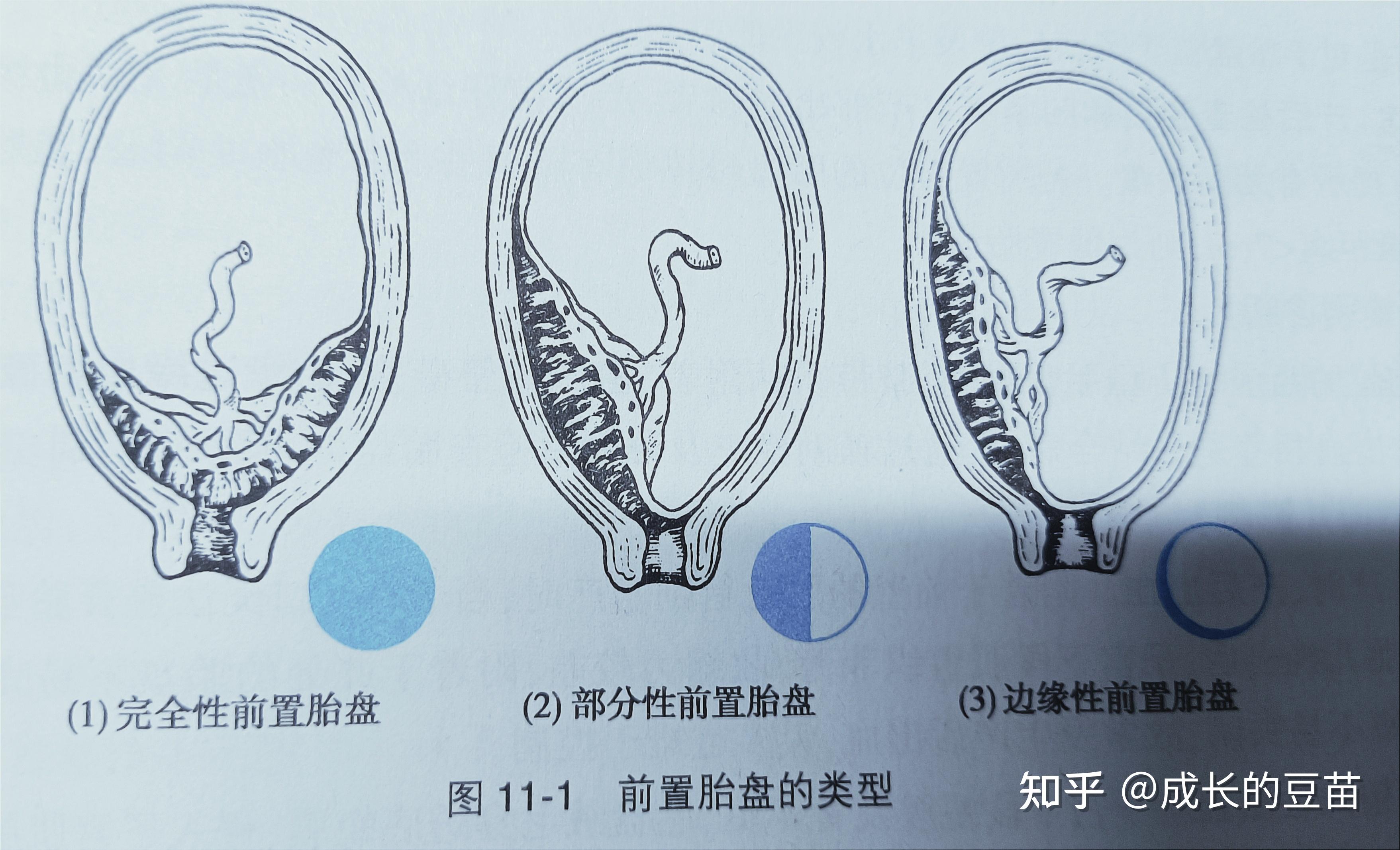 人胎盘是什么样子图片图片