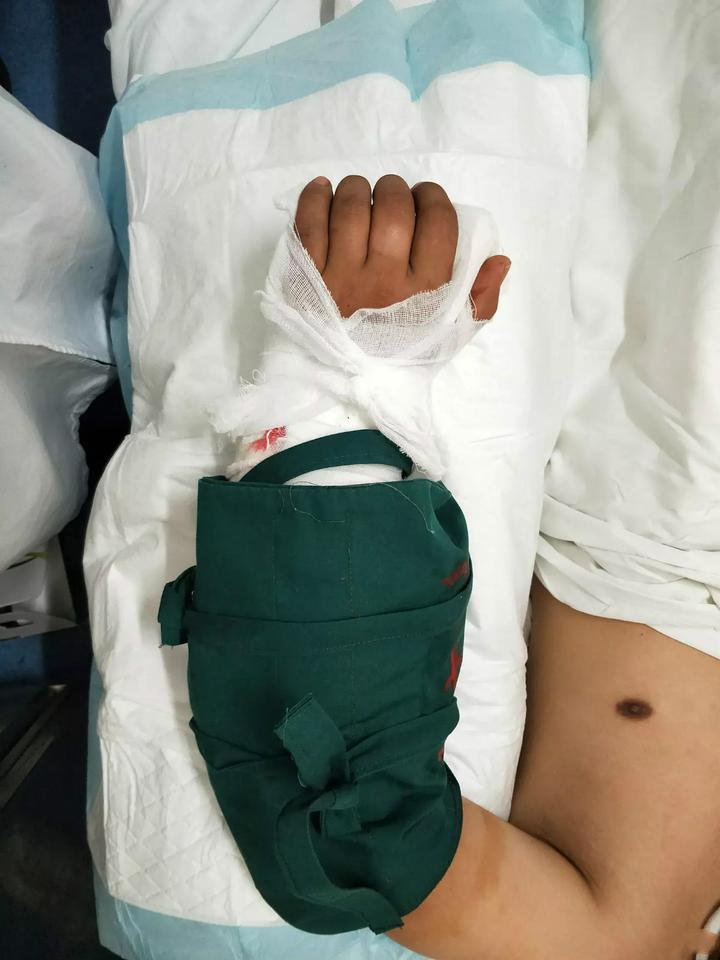 国庆假日惨剧:老李干活时把手臂锯断了