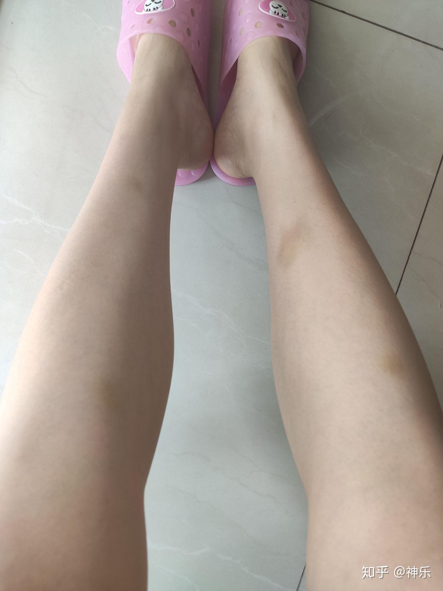 身上总会莫名其妙起淤青是什么原因? - 知乎