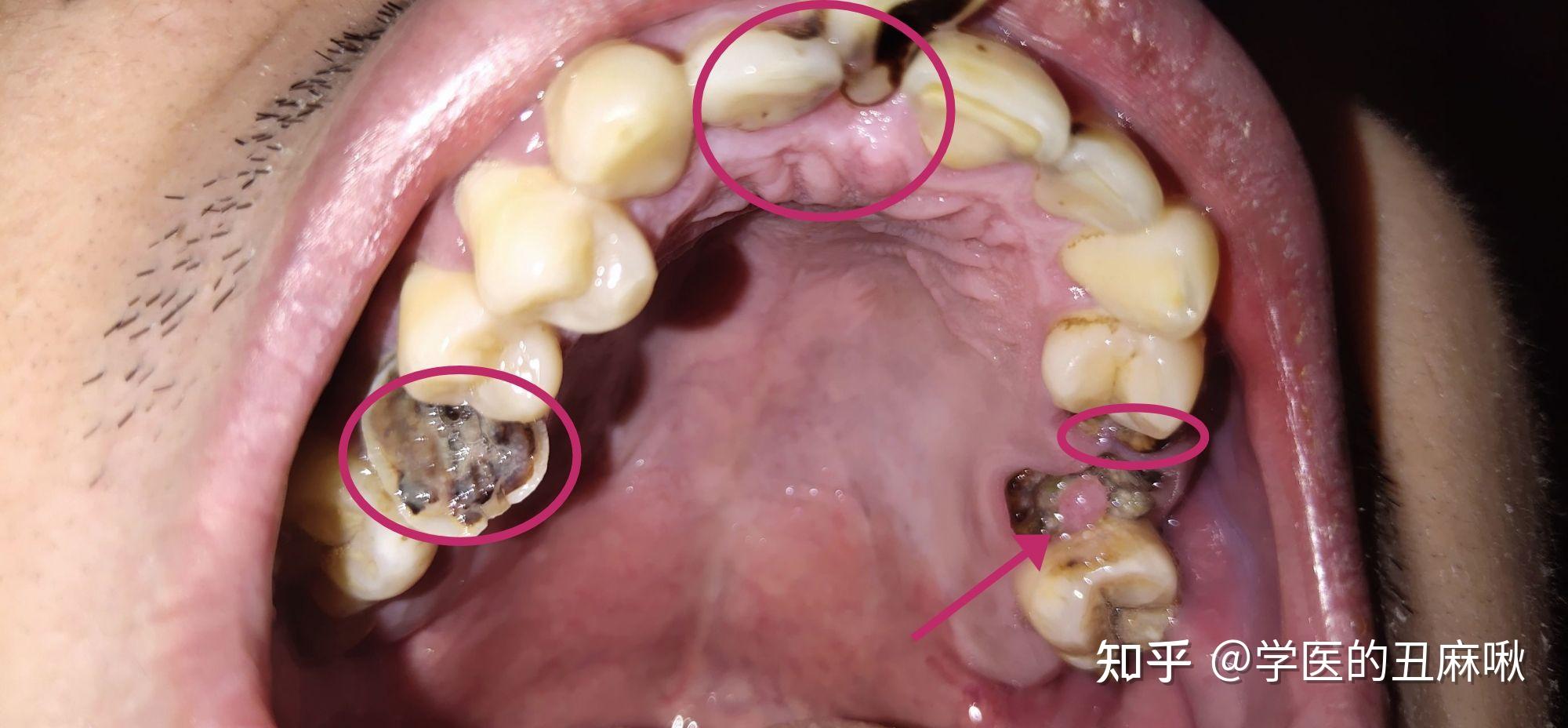 齲齒這個程度怎麼辦