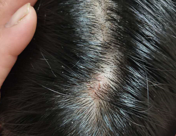 有人得过脂溢性角化症么,如何治好的?求回复～? - 知乎