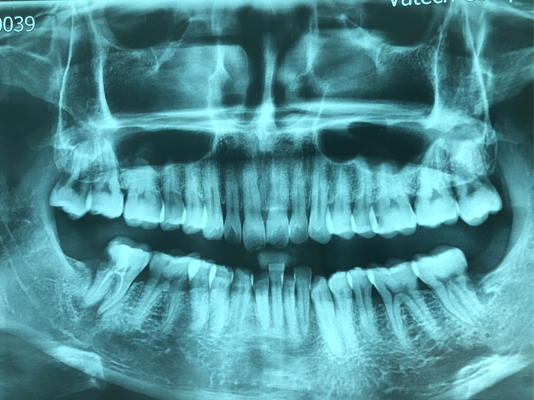 怎样判断牙周炎牙槽骨吸收程度