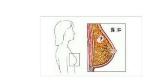 乳腺囊肿是怎么回事与2个因素有关是一种泌乳期高发疾病