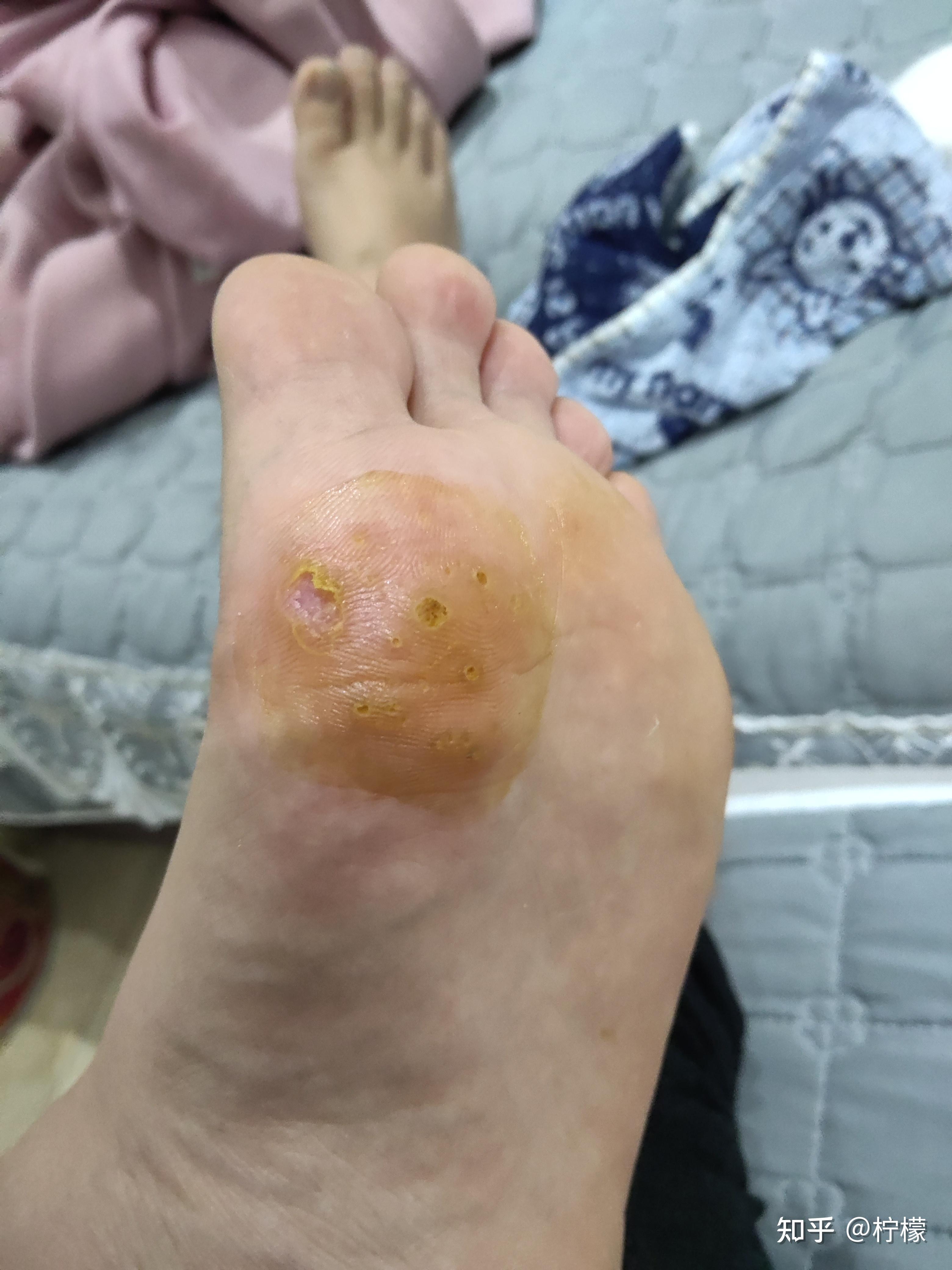 跖疣的自愈性大吗? - 知乎