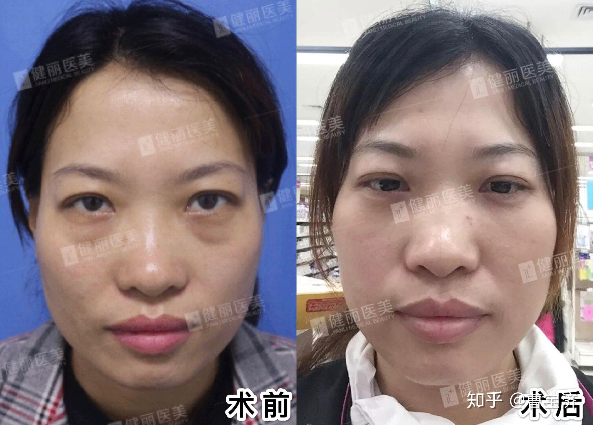 北京祛眼袋——内切眶隔术后6个月 - 知乎