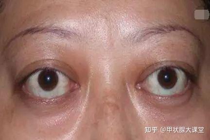 甲状腺大课堂:甲亢突眼要分级别 你知道吗? - 知乎