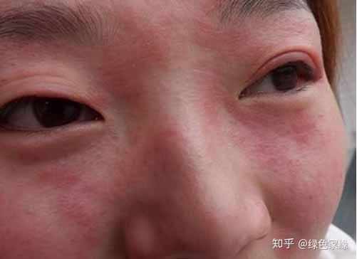 甲醛过敏怎么治疗? - 知乎