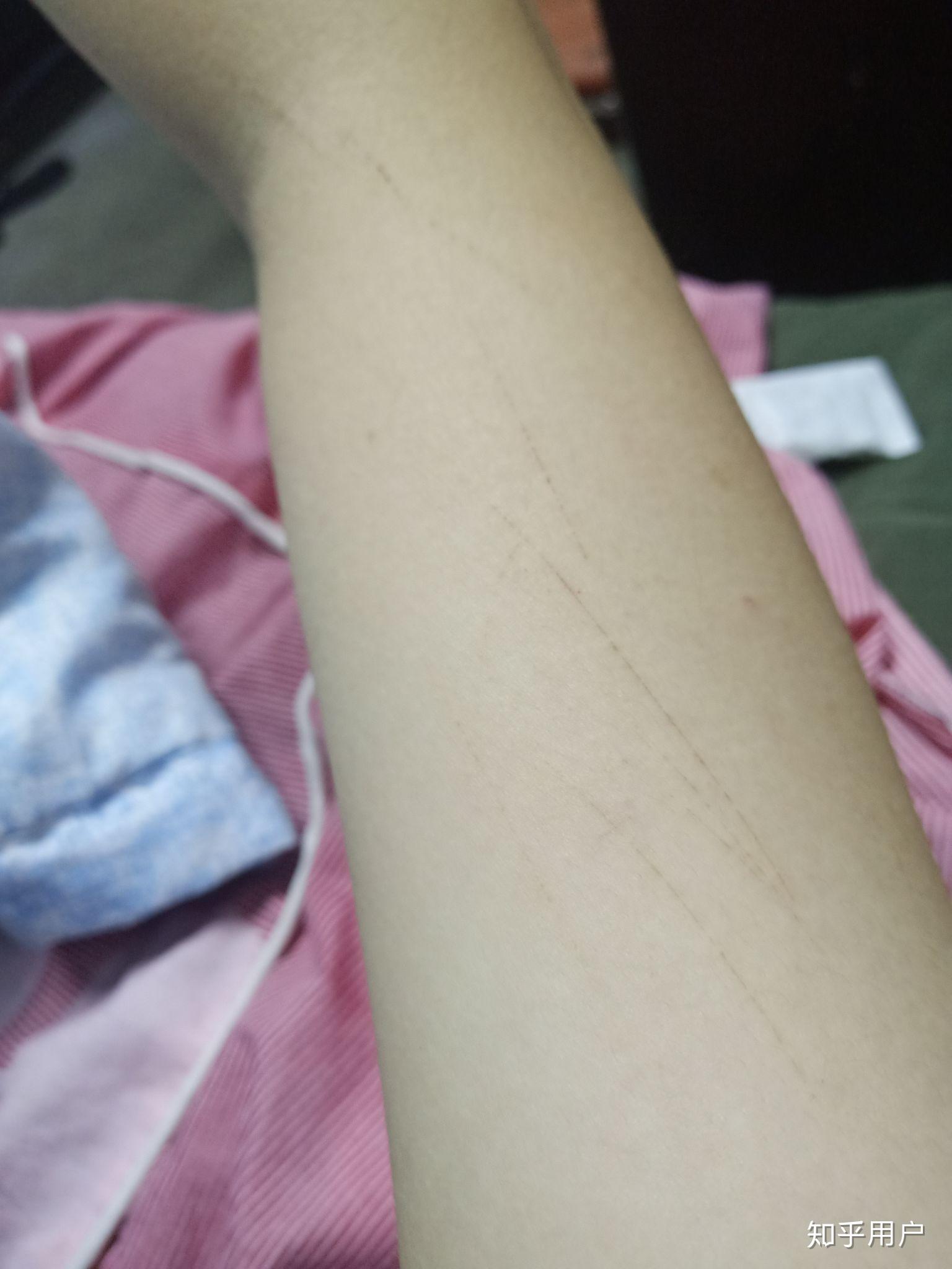 手臂莫名其妙出现伤痕是怎么回事? - 知乎