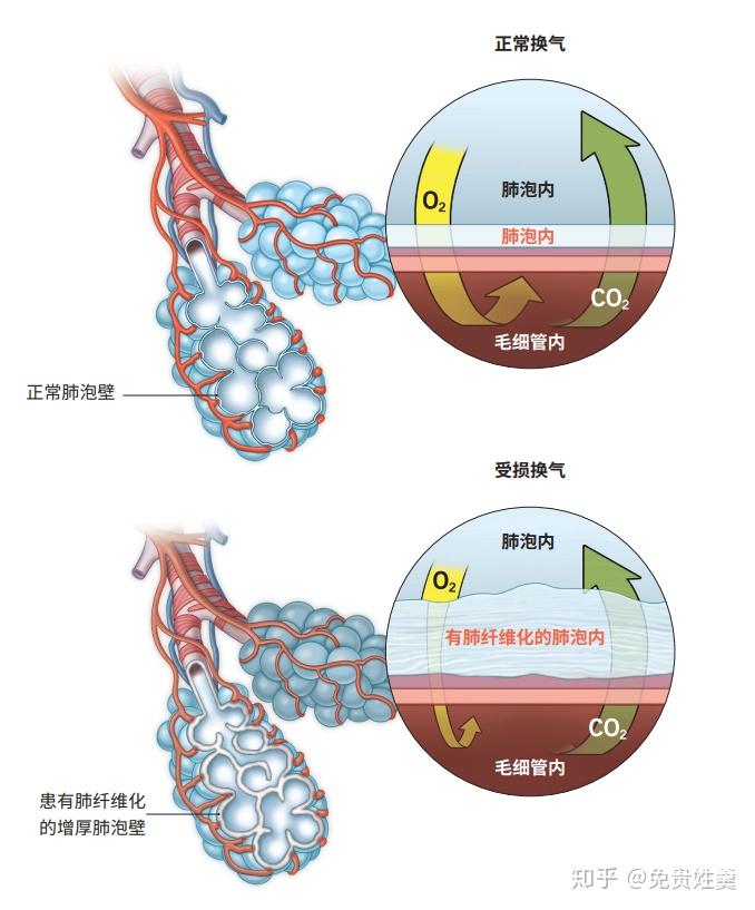 肺纤维化和肺癌有区别吗