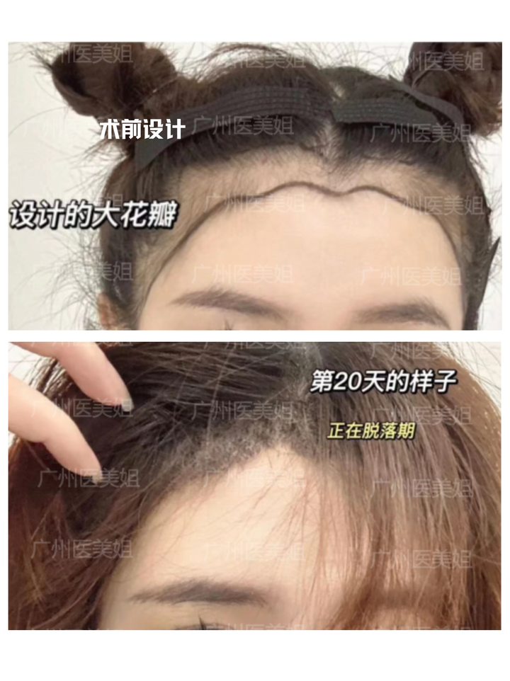 植发要多少钱？大花瓣发际线有多好看？ - 知乎