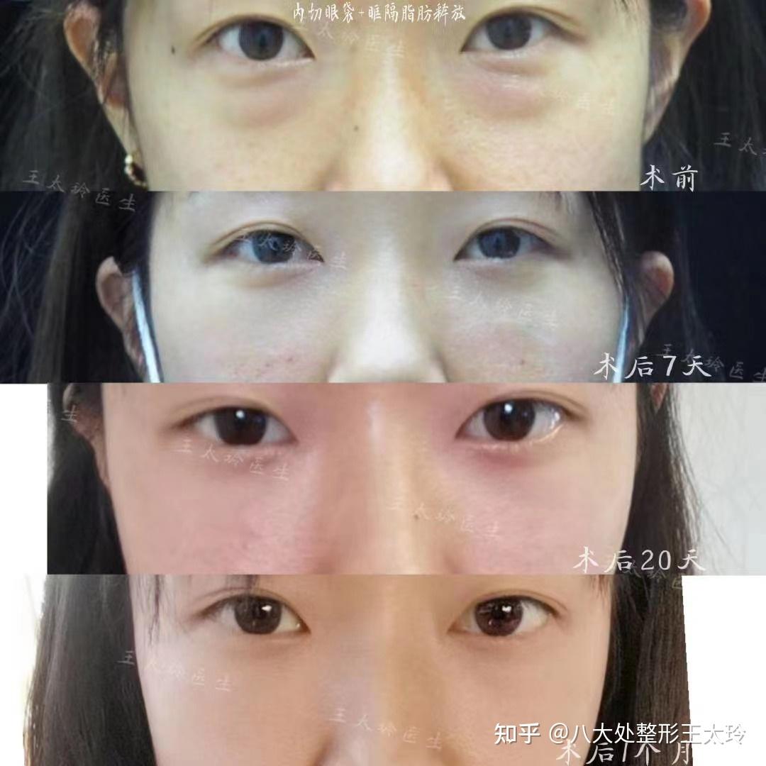 北京眼袋眶隔释放谁做的好，眶隔释放到底值得做吗？ - 知乎