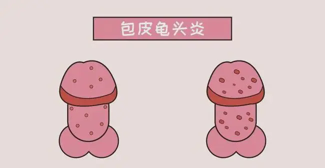 男性龟头炎能不能用盐水消毒丨护康泰