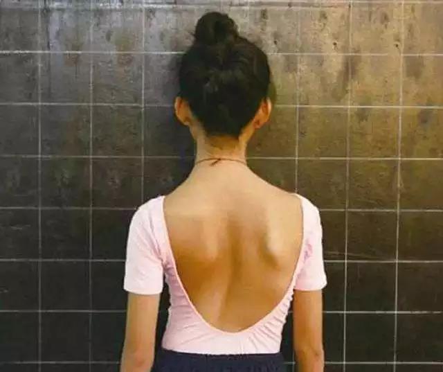 脊柱侧弯如何通过训练矫正呢