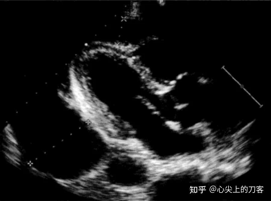 超声测量心包积液 - 知乎