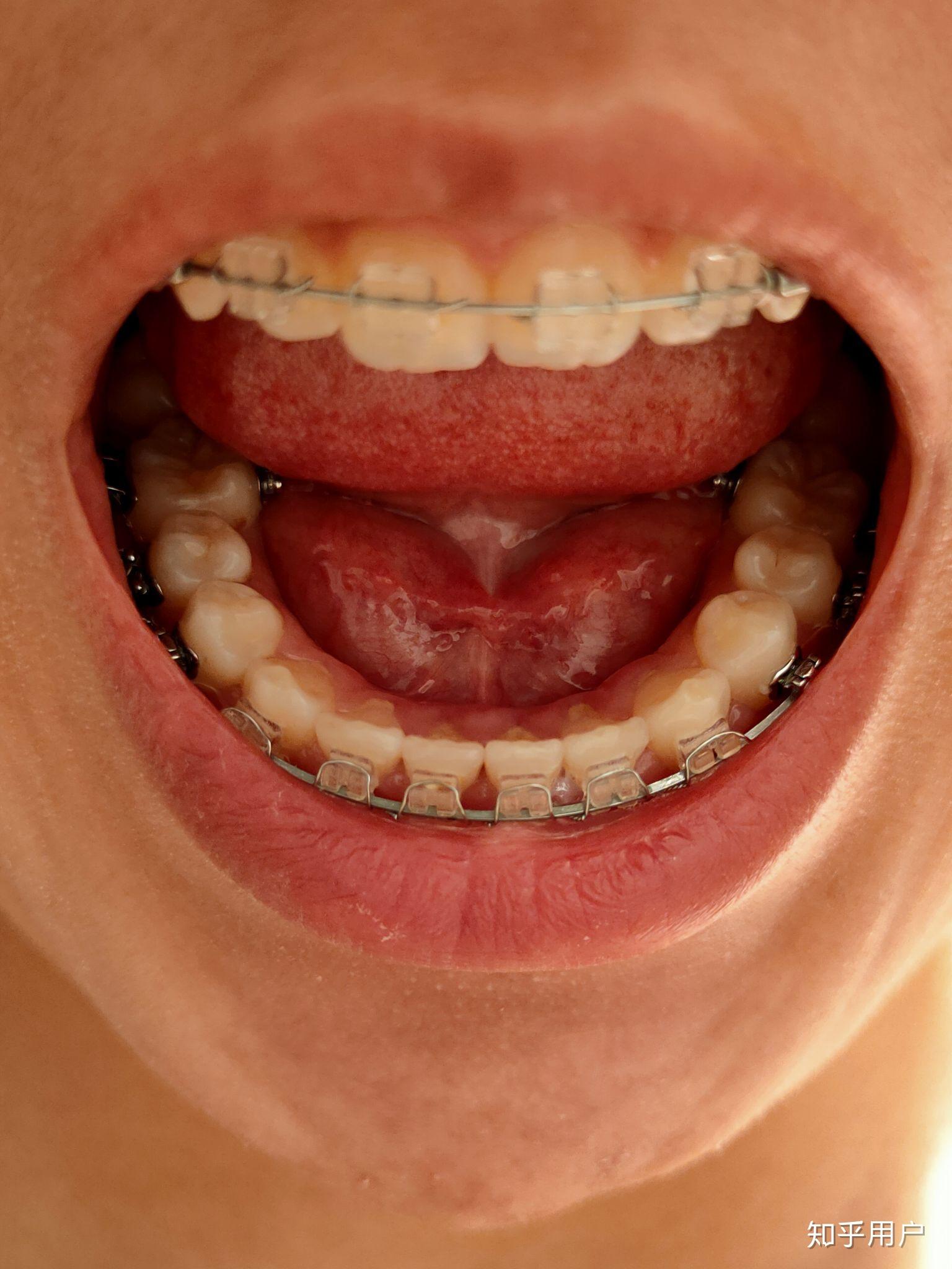 我的下牙是内倾的吗