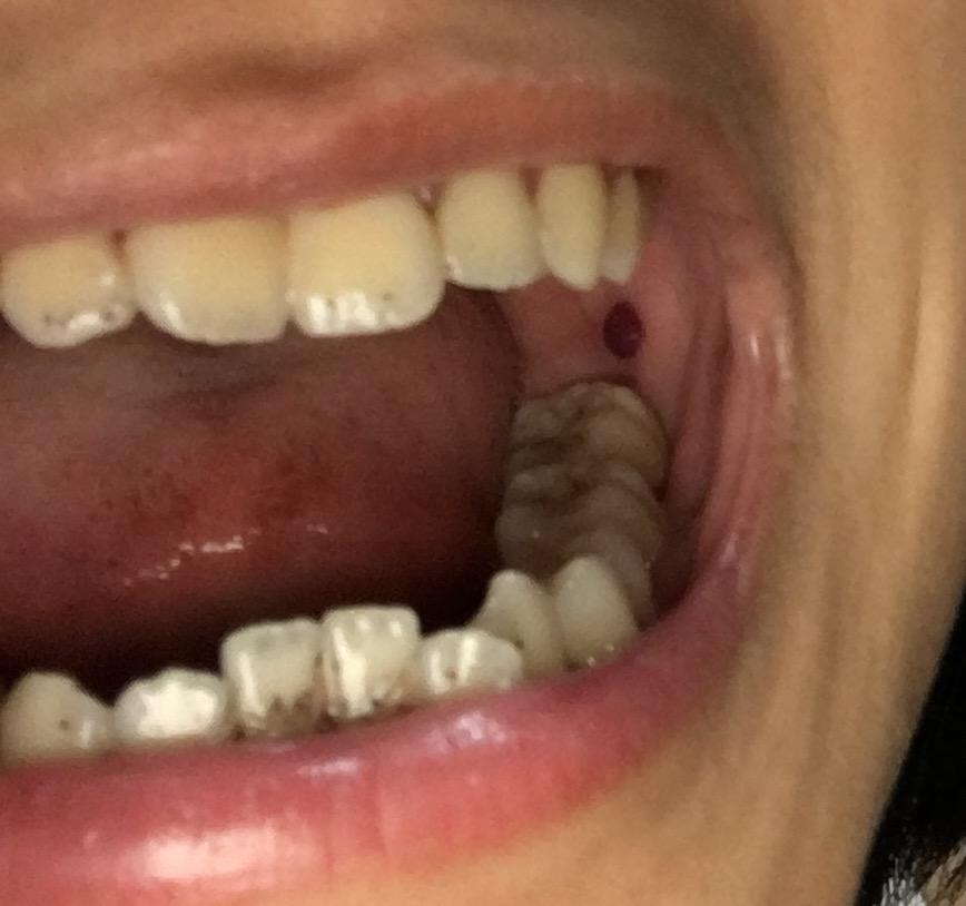 嘴巴里面腮处起了个黑色血泡是怎么回事? - 知乎