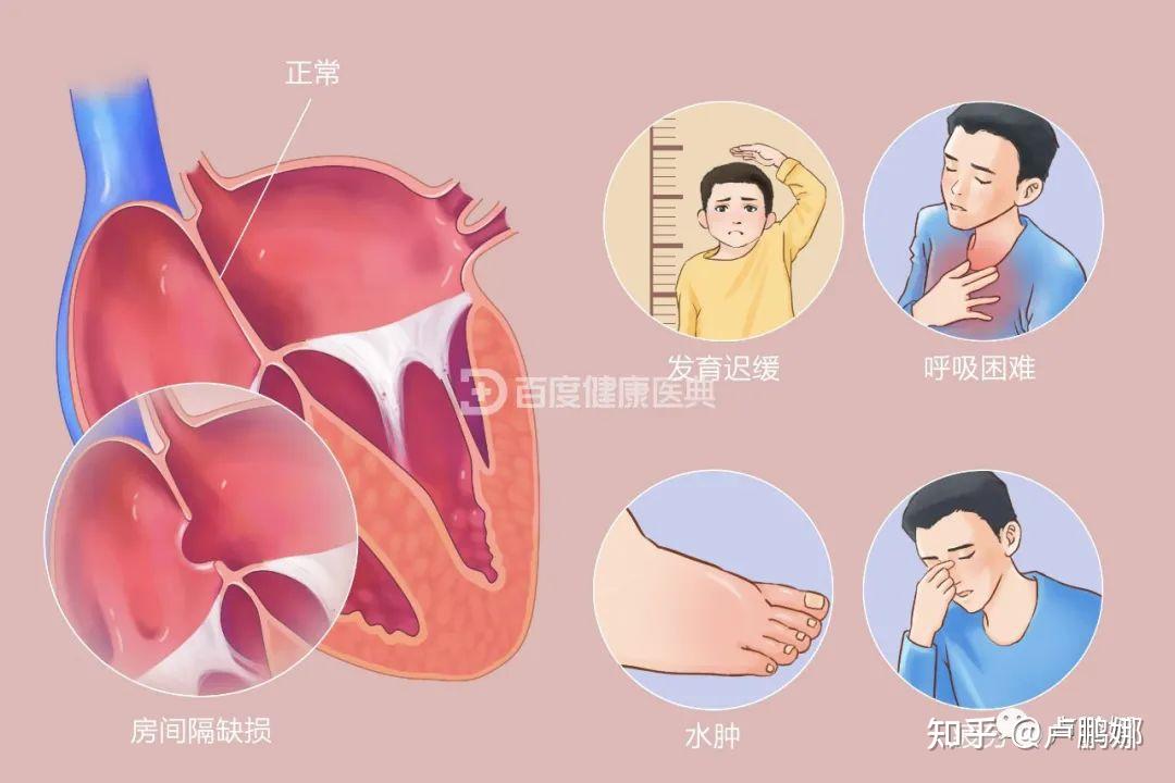 疾病投保指南丨房间隔缺损,怎么买保险? - 知乎