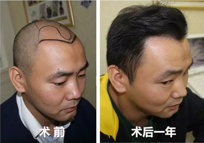 植发技术怎么选？什么是fue和fut，两者植发技术有什么差别吗？ - 知乎