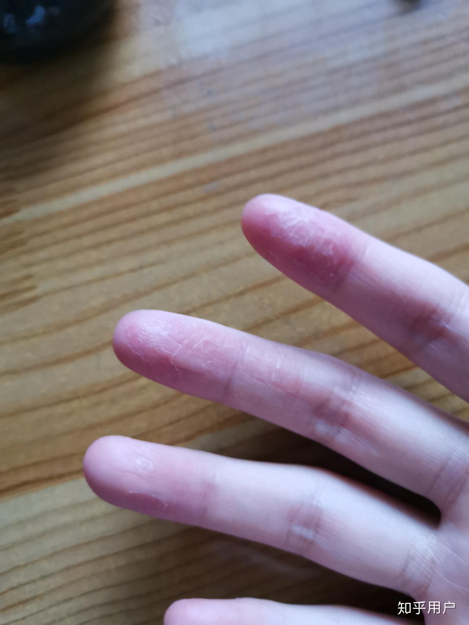 手指尖脱皮与气候季节的相关性是怎么形成的