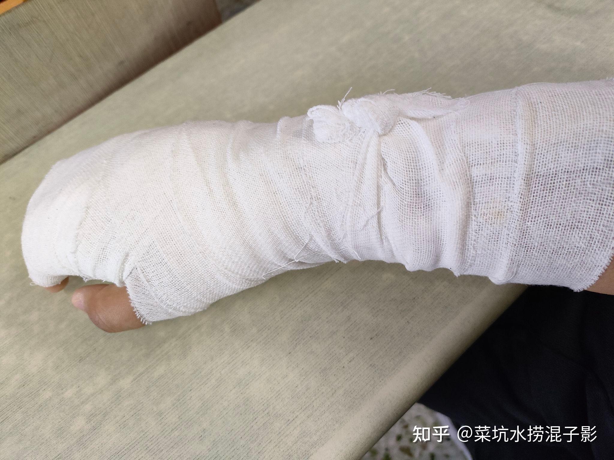 骨折日记右手第四掌骨骨折断端错位