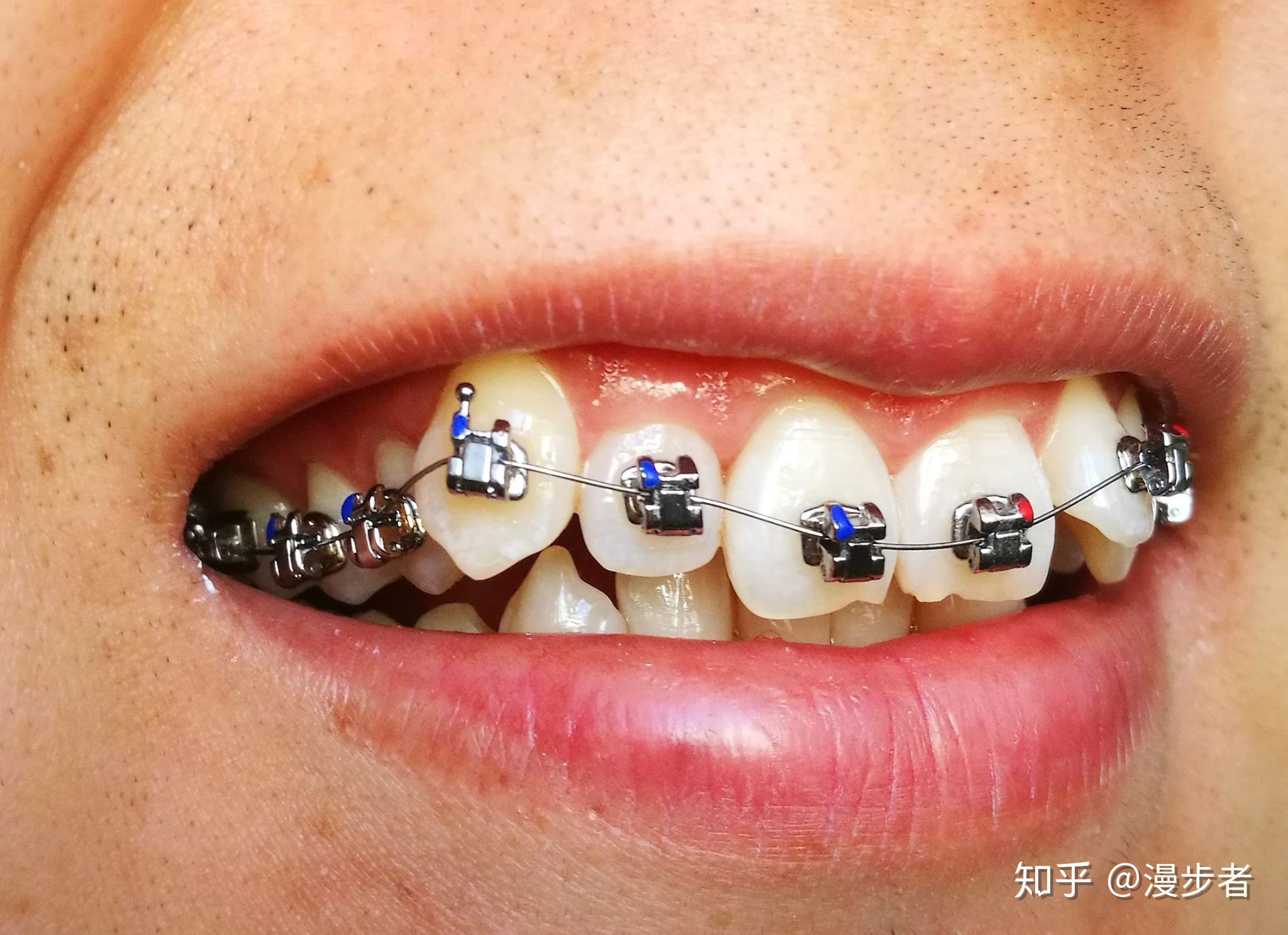 正畸用的进口的自锁托槽和国产的自锁托槽有什么区别? - 知乎