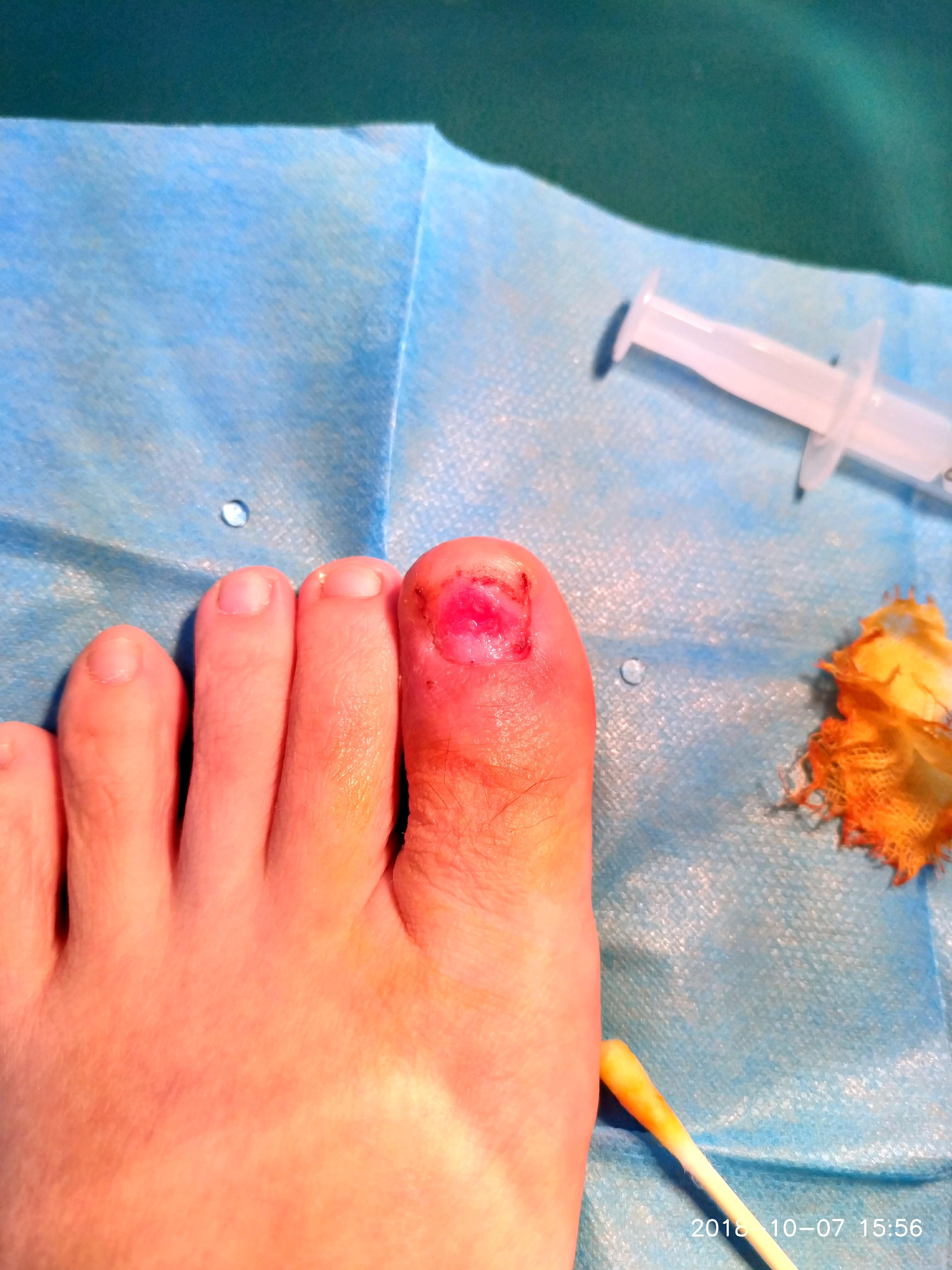 甲沟炎拔甲是怎样的体验