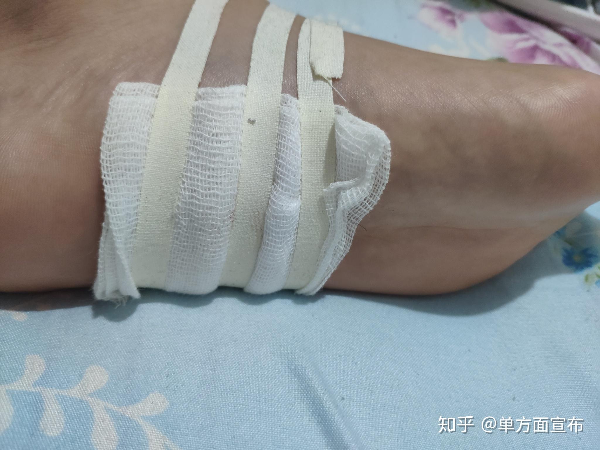 脚上扎了钉子刚开始不疼现在疼的要命