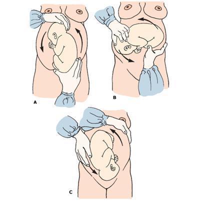 臀位宝宝华丽转身变头位,实现顺产!